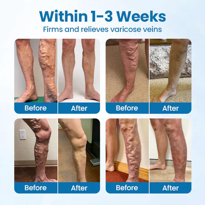 🎁Ourlyard® VeinGuard Herbal Spray – ✅ Clinically proven to eliminate varicose veins in just 7 days!
