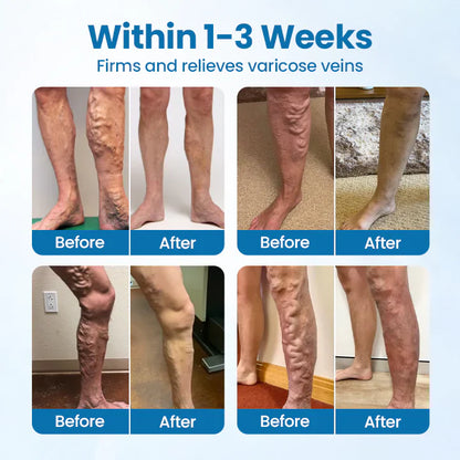 🎁Ourlyard® VeinGuard Herbal Spray – ✅ Clinically proven to eliminate varicose veins in just 7 days!