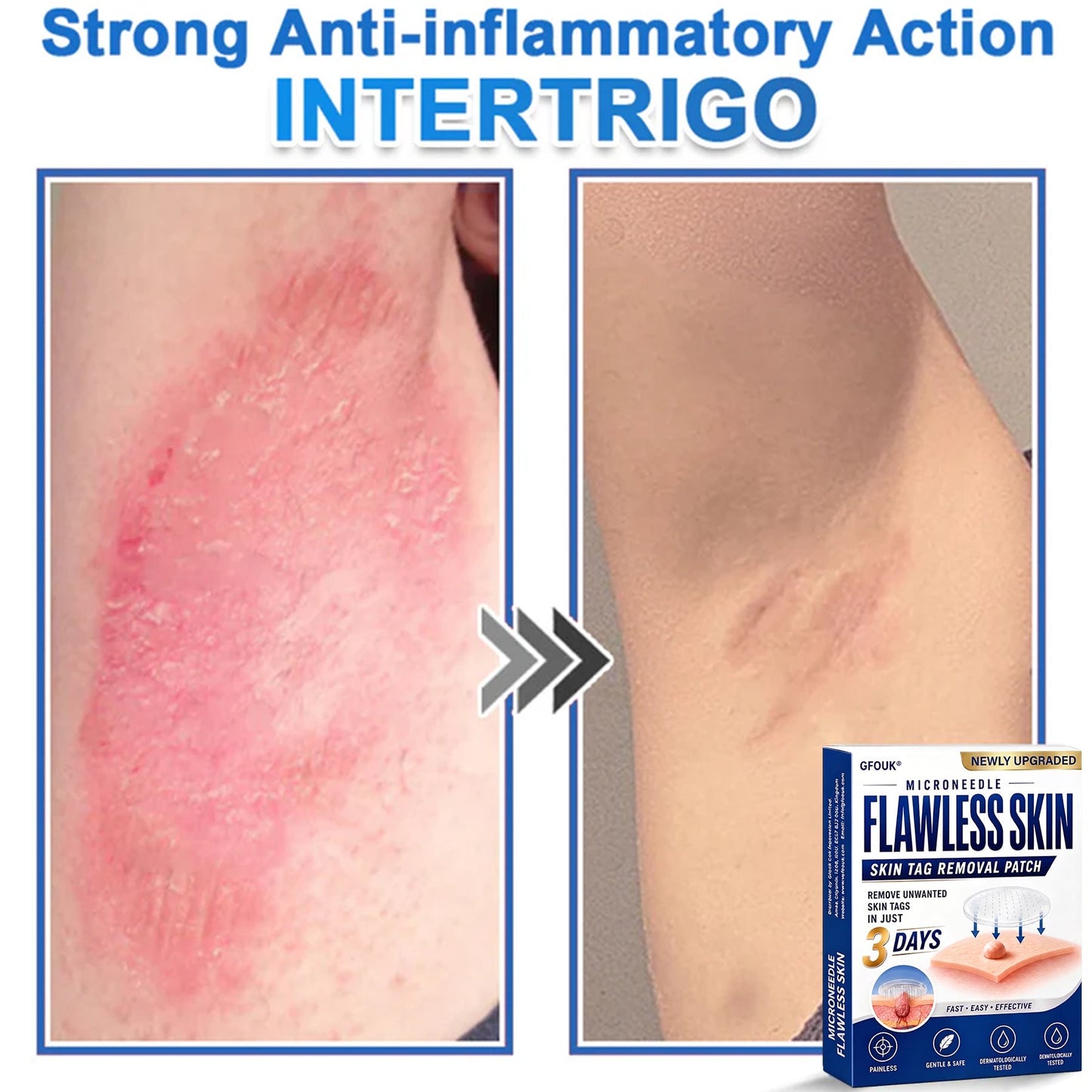 🎁Enjoy 30% OFF for adding the second one 🔥- GFOUK® Acne Patches