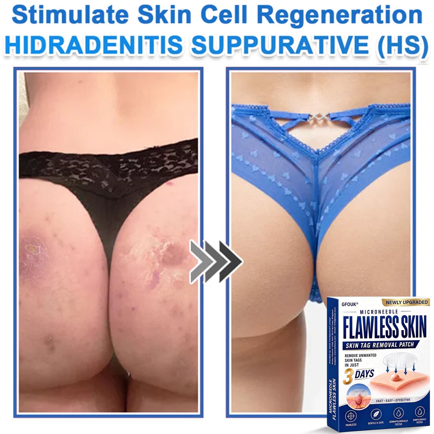 🎁Enjoy 30% OFF for adding the second one 🔥- GFOUK® Acne Patches