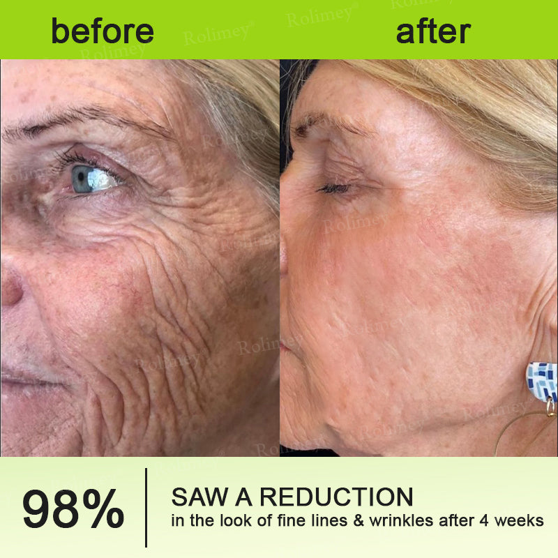 🔥Made and shipped from Australia 💫Rolimey® Botox & Vita-A Retinol Shot Wrinkle-Lift Tightening cream - Last Day Promotion 70% OFF