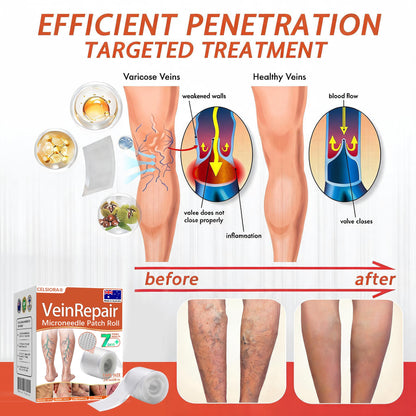 🧑‍⚕️🧑‍⚕️Celsiora® Vein Ease Microneedle Care Patch(For Spider Veins, Varicose Veins, Swelling & Leg Fatigue) - Last Day Promotion 50% OFF