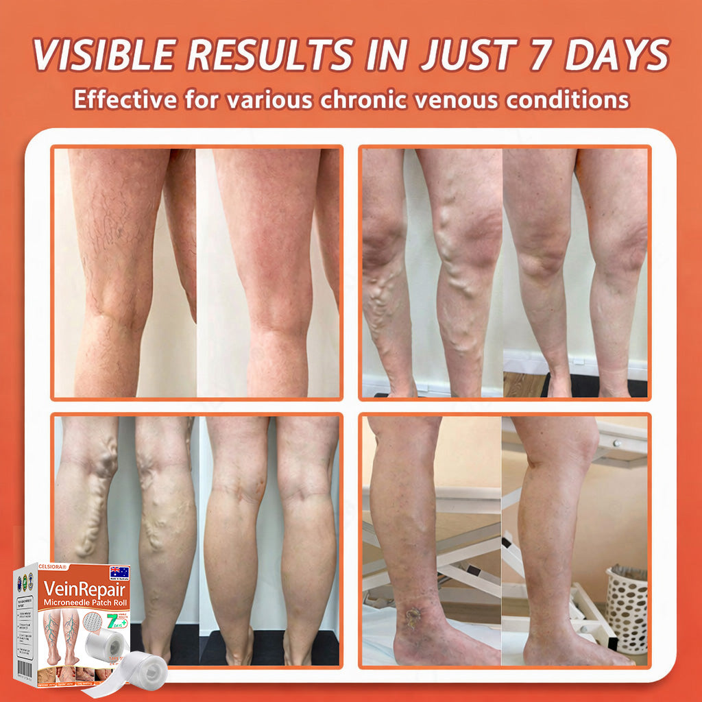 🧑‍⚕️🧑‍⚕️Celsiora® Vein Ease Microneedle Care Patch(For Spider Veins, Varicose Veins, Swelling & Leg Fatigue) - Last Day Promotion 50% OFF