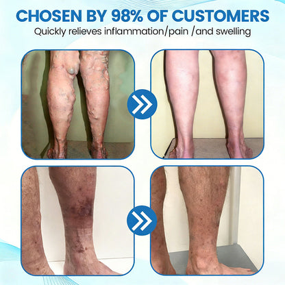 🇦🇺🥇✅🌿GFOUK® VEINRX Healing Spray (Designed for Varicose veins, Spider veins, Deep vein Thrombosis, Chronic venous insufficiency, Venous ulcers, Thrombophlebitis and other venous issues)