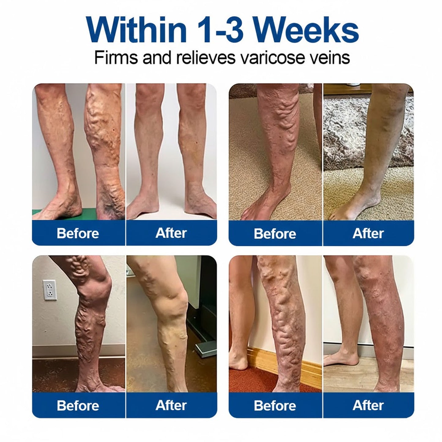 🇦🇺👨‍⚕️🔥GFOUK® VeinEase Microneedle Care Patch⚡Instant Relief, Long-Term Results