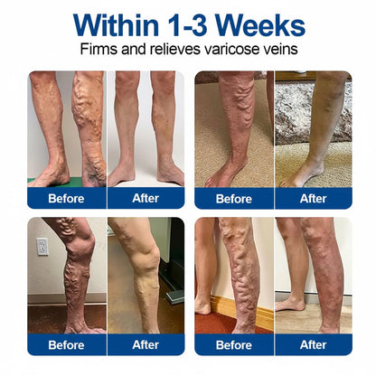 🇦🇺👨‍⚕️🔥GFOUK® VeinEase Microneedle Care Patch⚡Instant Relief, Long-Term Results