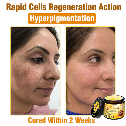 ✨Ourlyard® Bee Venom Skin Restoration Cream — 🔥Limited Time 80% OFF🔥