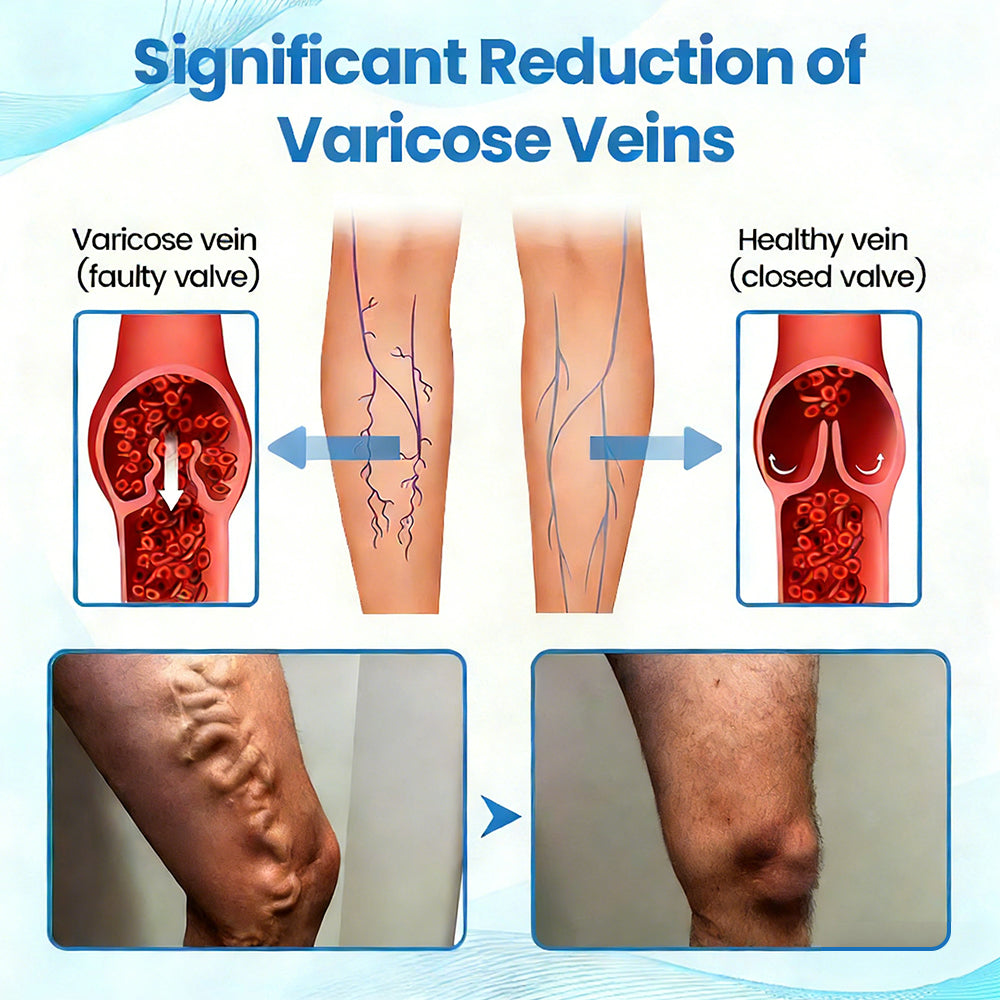 🇦🇺🥇✅🌿GFOUK® VEINRX Healing Spray (Designed for Varicose veins, Spider veins, Deep vein Thrombosis, Chronic venous insufficiency, Venous ulcers, Thrombophlebitis and other venous issues)