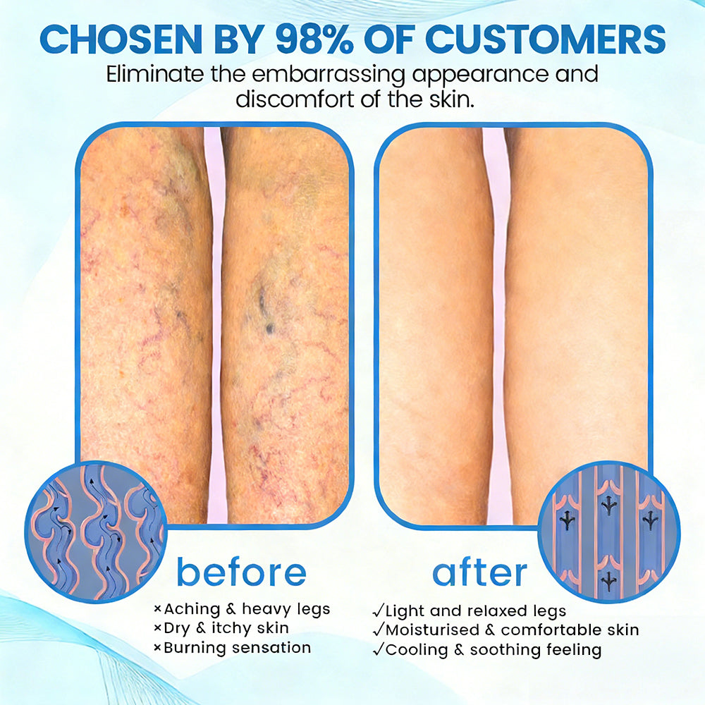 🇦🇺🥇✅🌿GFOUK® VEINRX Healing Spray (Designed for Varicose veins, Spider veins, Deep vein Thrombosis, Chronic venous insufficiency, Venous ulcers, Thrombophlebitis and other venous issues)