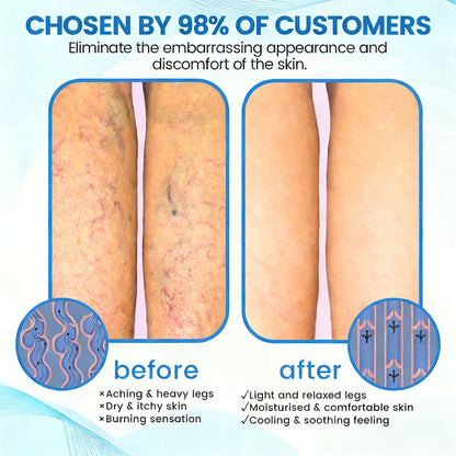 🇦🇺🥇✅🌿GFOUK® VEINRX Healing Spray (Designed for Varicose veins, Spider veins, Deep vein Thrombosis, Chronic venous insufficiency, Venous ulcers, Thrombophlebitis and other venous issues)