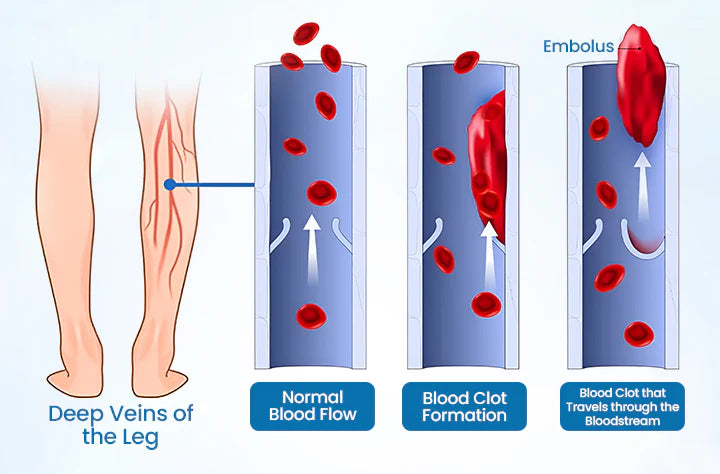 🔥Ourlyard® VeinGuard Herbal Spray – ✅ Clinically proven to eliminate varicose veins in just 7 days!