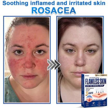 🎁Enjoy 30% OFF for adding the second one 🔥- GFOUK® Acne Patches