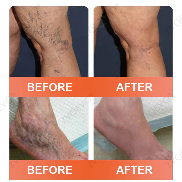 🧑‍⚕️🧑‍⚕️Celsiora® Vein Ease Microneedle Care Patch(For Spider Veins, Varicose Veins, Swelling & Leg Fatigue) - Last Day Promotion 50% OFF