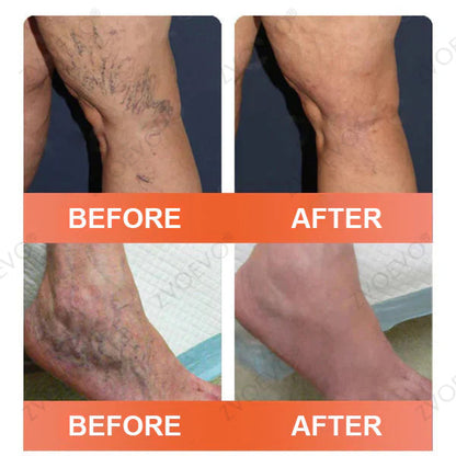 🧑‍⚕️🧑‍⚕️Celsiora® Vein Ease Microneedle Care Patch(For Spider Veins, Varicose Veins, Swelling & Leg Fatigue) - Last Day Promotion 50% OFF