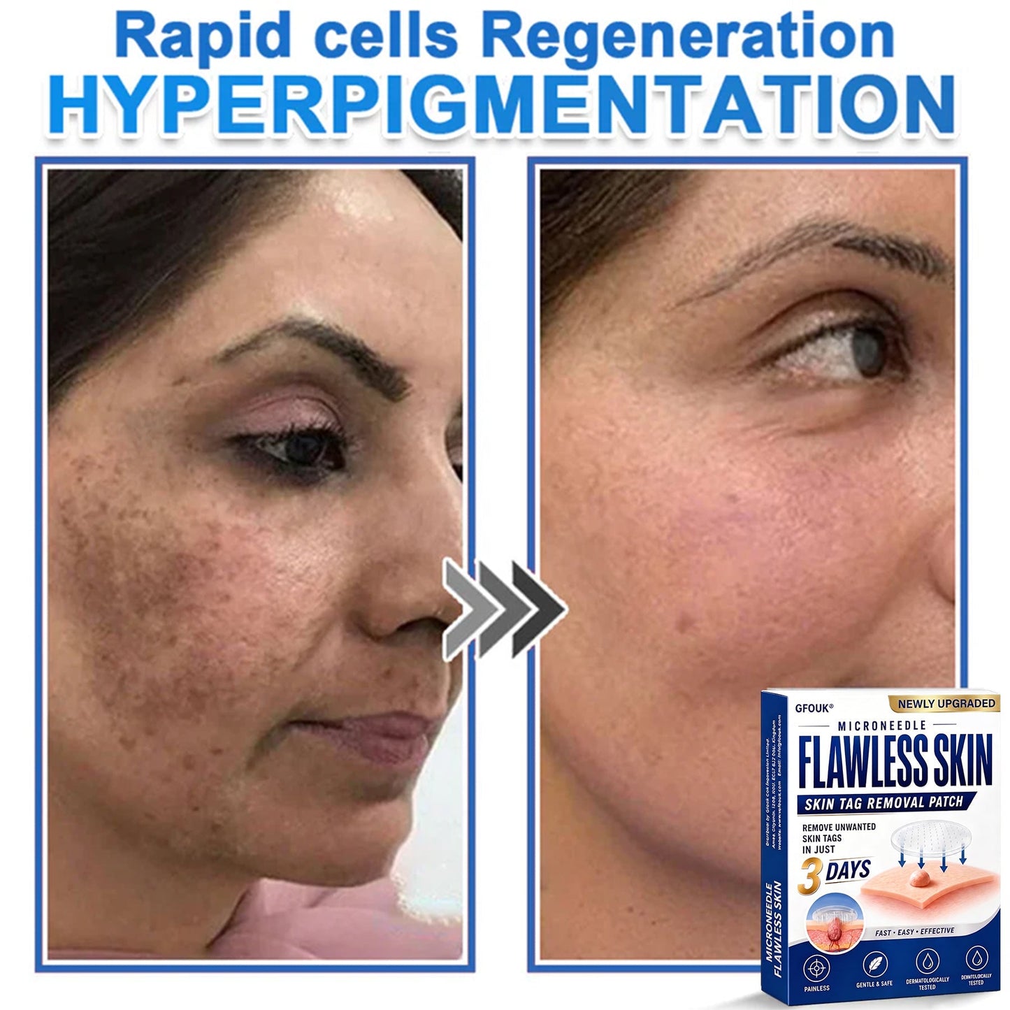 🎁Enjoy 30% OFF for adding the second one 🔥- GFOUK® Acne Patches