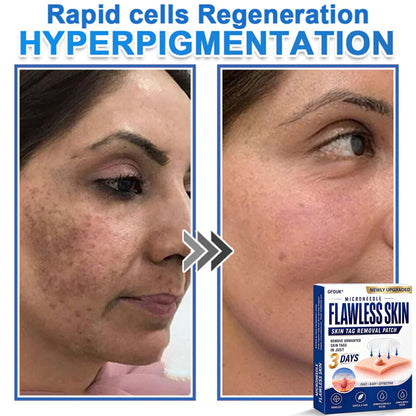 🎁Enjoy 30% OFF for adding the second one 🔥- GFOUK® Acne Patches