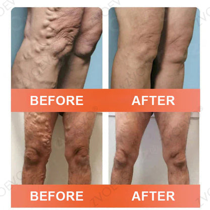 🧑‍⚕️🧑‍⚕️Celsiora® Vein Ease Microneedle Care Patch(For Spider Veins, Varicose Veins, Swelling & Leg Fatigue) - Last Day Promotion 50% OFF